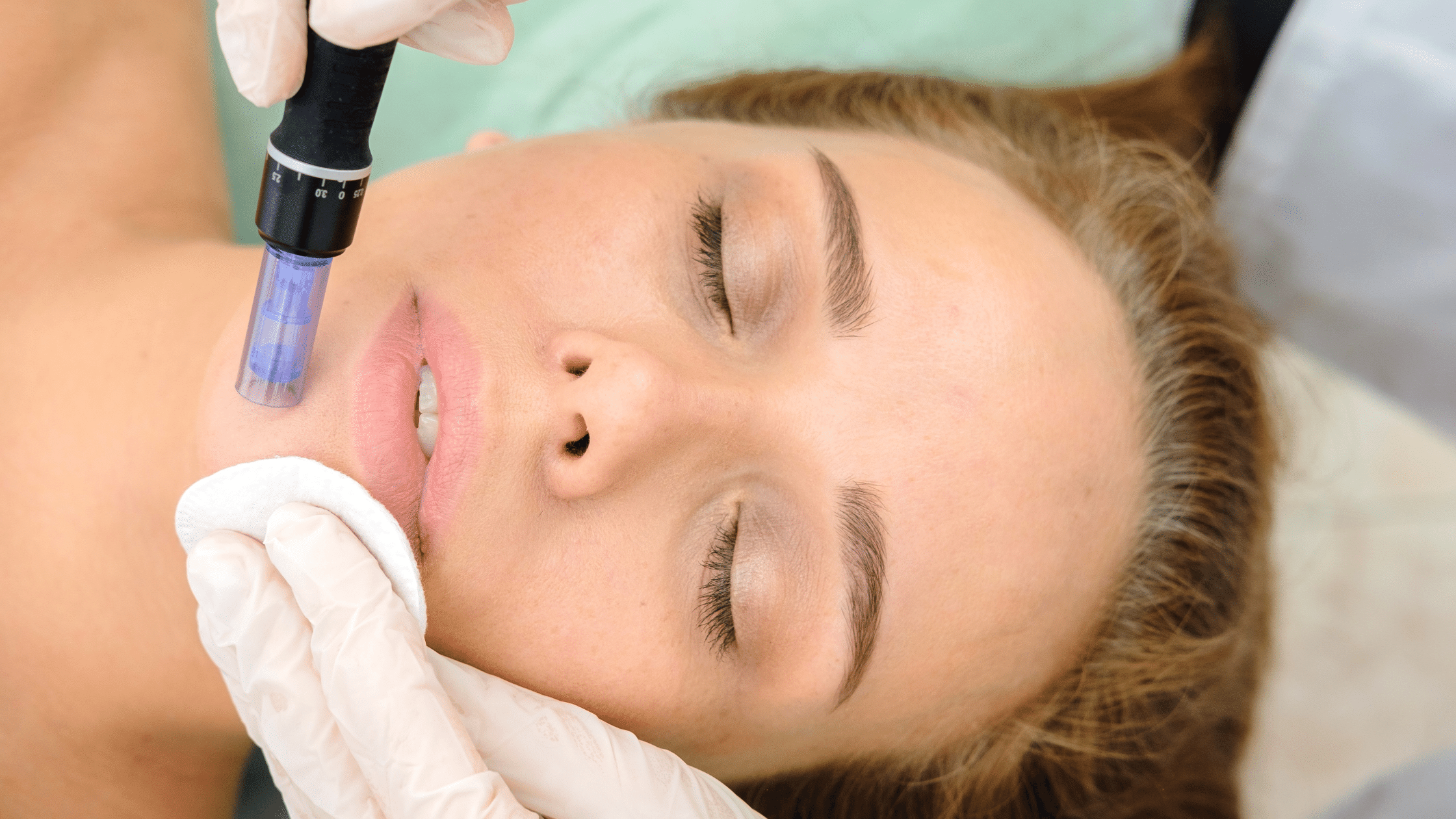 microneedling+blog